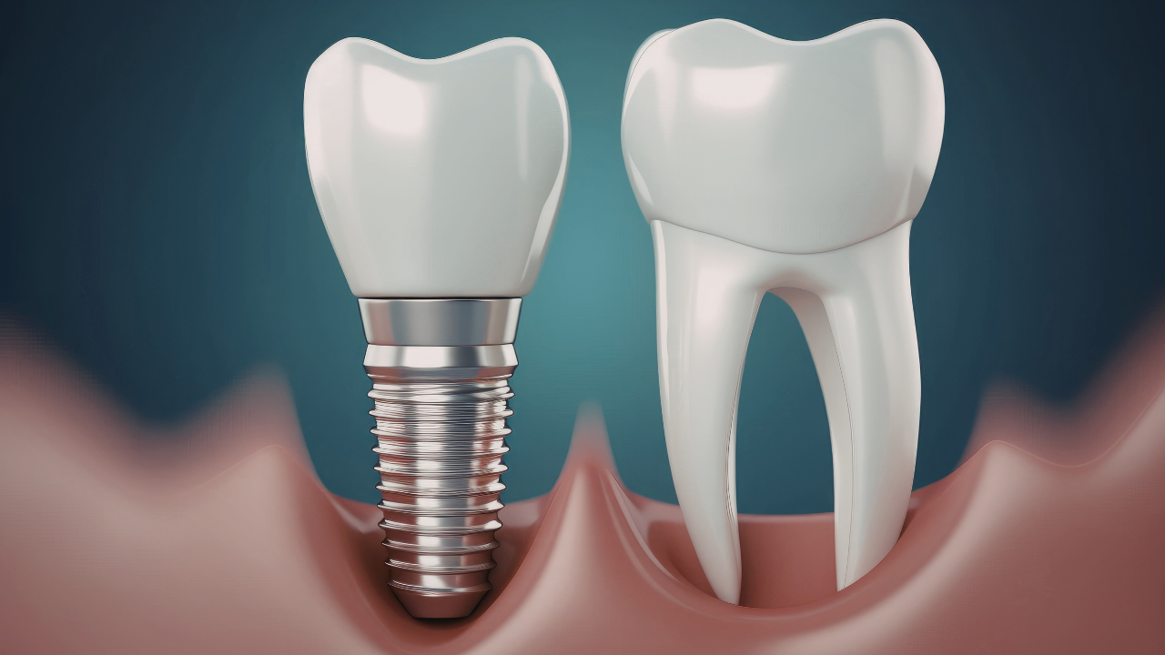 Implante dentário
